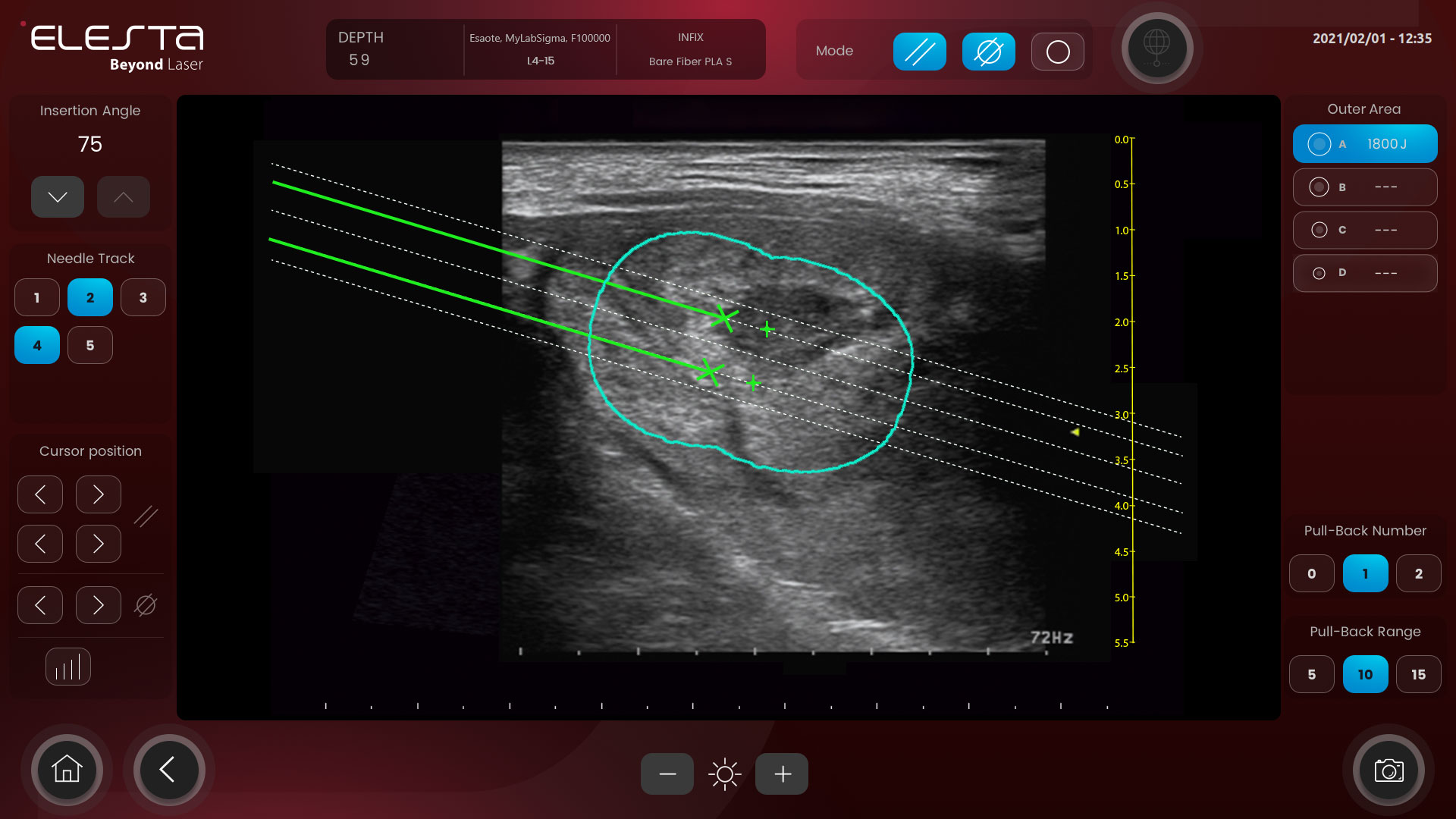 licr-applications-schermata Esempio di corretta pianificazione pre-trattamento per lesioni benigne
